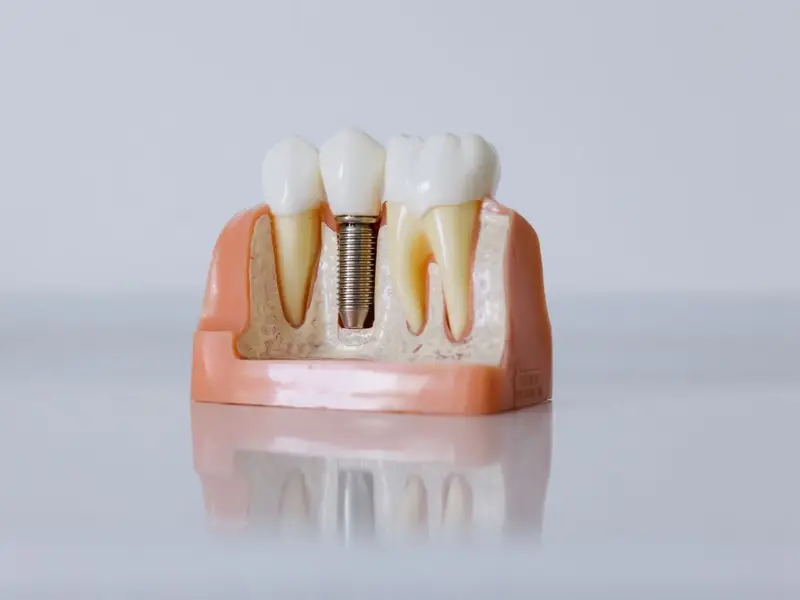 A cutaway model showing a dental implant set into the jaw